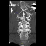 Jefferson Fracture and the Classification System for Atlas Fractures, A Case Report 2 Creative Commons images