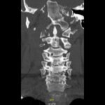 Jefferson Fracture and the Classification System for Atlas Fractures, A Case Report 1 Creative Commons images