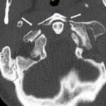 Jefferson Fracture and the Classification System for Atlas Fractures, A Case Report 4 Creative Commons images