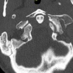 Jefferson Fracture and the Classification System for Atlas Fractures, A Case Report 3 Creative Commons images