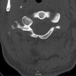 Jefferson Fracture and the Classification System for Atlas Fractures, A Case Report 5 Creative Commons images