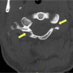 Jefferson Fracture and the Classification System for Atlas Fractures, A Case Report 6 Creative Commons images