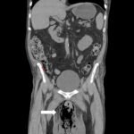 Using Point-of-Care Ultrasound to Expedite Diagnosis of Necrotizing Fasciitis: A Case Report 5 Creative Commons images