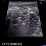 Using Point-of-Care Ultrasound to Expedite Diagnosis of Necrotizing Fasciitis: A Case Report 2 Creative Commons images