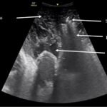 Using Point-of-Care Ultrasound to Expedite Diagnosis of Necrotizing Fasciitis: A Case Report 4 Creative Commons images