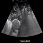 Using Point-of-Care Ultrasound to Expedite Diagnosis of Necrotizing Fasciitis: A Case Report 3 Creative Commons images