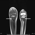 A Boy with Rash and Joint Pain Diagnosed with Scurvy: A Case Report 2 Creative Commons images