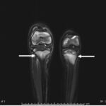 A Boy with Rash and Joint Pain Diagnosed with Scurvy: A Case Report 1 Creative Commons images