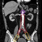 Initial Management and Recognition of Aortoiliac Occlusive Disease, A Case Report 2 Creative Commons images