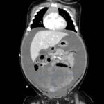 Ovarian Juvenile Granulosa Cell Tumor Case Report 5 Creative Commons images