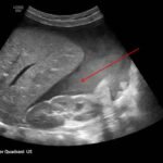 Ovarian Juvenile Granulosa Cell Tumor Case Report 6 Creative Commons images