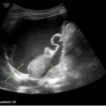 Ovarian Juvenile Granulosa Cell Tumor Case Report 7 Creative Commons images