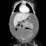 Ovarian Juvenile Granulosa Cell Tumor Case Report 1 Creative Commons images