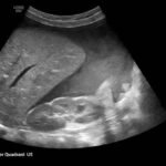 Ovarian Juvenile Granulosa Cell Tumor Case Report 2 Creative Commons images