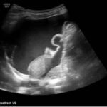 Ovarian Juvenile Granulosa Cell Tumor Case Report 3 Creative Commons images