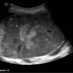 Ovarian Juvenile Granulosa Cell Tumor Case Report 4 Creative Commons images