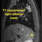 An Unusual Case Report of a Toddler with Metastatic Neuroblastoma Mimicking Myasthenia Gravis 2 Creative Commons images