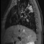 An Unusual Case Report of a Toddler with Metastatic Neuroblastoma Mimicking Myasthenia Gravis 1 Creative Commons images