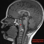 An Unusual Case Report of a Toddler with Metastatic Neuroblastoma Mimicking Myasthenia Gravis 4 Creative Commons images