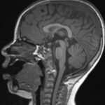 An Unusual Case Report of a Toddler with Metastatic Neuroblastoma Mimicking Myasthenia Gravis 3 Creative Commons images