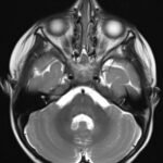 An Unusual Case Report of a Toddler with Metastatic Neuroblastoma Mimicking Myasthenia Gravis 5 Creative Commons images