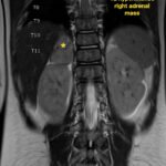 An Unusual Case Report of a Toddler with Metastatic Neuroblastoma Mimicking Myasthenia Gravis 8 Creative Commons images