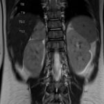 An Unusual Case Report of a Toddler with Metastatic Neuroblastoma Mimicking Myasthenia Gravis 7 Creative Commons images