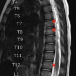 An Unusual Case Report of a Toddler with Metastatic Neuroblastoma Mimicking Myasthenia Gravis 10 Creative Commons images
