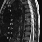 An Unusual Case Report of a Toddler with Metastatic Neuroblastoma Mimicking Myasthenia Gravis 9 Creative Commons images