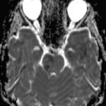 Pediatric Autoimmune Encephalitis. DWI Diffusion Signal Abnormality in Brainstem day 2. JETem 2022 1