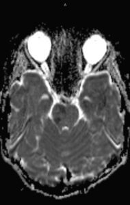 Pediatric Autoimmune Encephalitis. DWI Diffusion Signal Abnormality in Brainstem day 2. JETem 2022 1