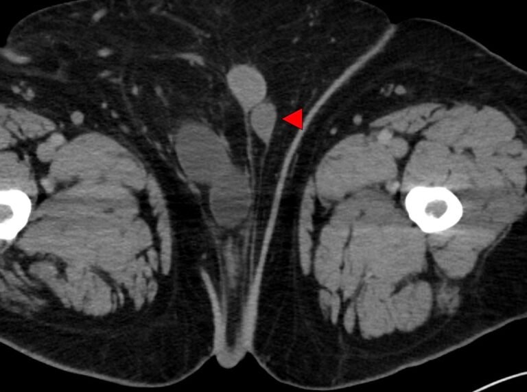 Pelvic Kidney with Ureteral Obstruction from Inguinal Hernia Entrapment ...