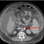 Unravelling the Mystery of a Continuous Coil: A Case Report 8 Creative Commons images