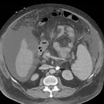 Unravelling the Mystery of a Continuous Coil: A Case Report 1 Creative Commons images