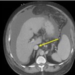 Unravelling the Mystery of a Continuous Coil: A Case Report 9 Creative Commons images