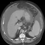 Unravelling the Mystery of a Continuous Coil: A Case Report 2 Creative Commons images