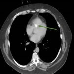 Unravelling the Mystery of a Continuous Coil: A Case Report 10 Creative Commons images