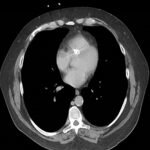 Unravelling the Mystery of a Continuous Coil: A Case Report 3 Creative Commons images