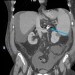 Unravelling the Mystery of a Continuous Coil: A Case Report 11 Creative Commons images