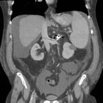 Unravelling the Mystery of a Continuous Coil: A Case Report 4 Creative Commons images
