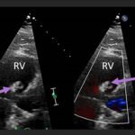 Unravelling the Mystery of a Continuous Coil: A Case Report 12 Creative Commons images