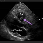Unravelling the Mystery of a Continuous Coil: A Case Report 13 Creative Commons images