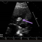 Unravelling the Mystery of a Continuous Coil: A Case Report 14 Creative Commons images
