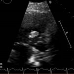 Unravelling the Mystery of a Continuous Coil: A Case Report 7 Creative Commons images