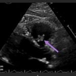Unravelling the Mystery of a Continuous Coil: A Case Report 15 Creative Commons images