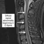 Transverse Myelitis in Naloxone Reversible Acute Respiratory Failure. C Spine MRI Annotation. JETem 2022 1