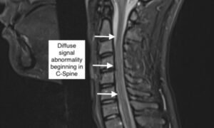 Transverse Myelitis in Naloxone Reversible Acute Respiratory Failure. C Spine MRI Annotation. JETem 2022 1