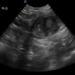 Imaging Findings of Small Bowel - Diverticulitis: A Case Report 4 Creative Commons images