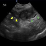 Imaging Findings of Small Bowel - Diverticulitis: A Case Report 2 Creative Commons images