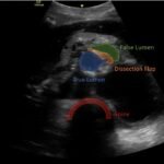 Aortic Dissection Case Report 5 Creative Commons images